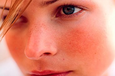 I “ROSSORI” DA ROSACEA: ECCO LE ARMI PER COMBATTERLI