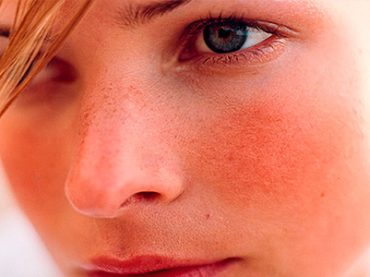 I “ROSSORI” DA ROSACEA: ECCO LE ARMI PER COMBATTERLI