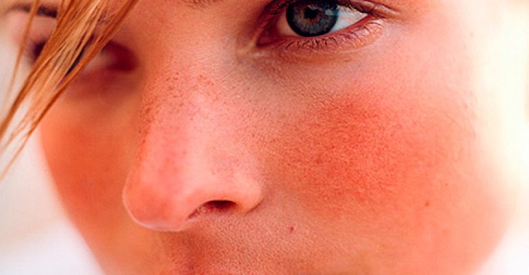 I “ROSSORI” DA ROSACEA: ECCO LE ARMI PER COMBATTERLI