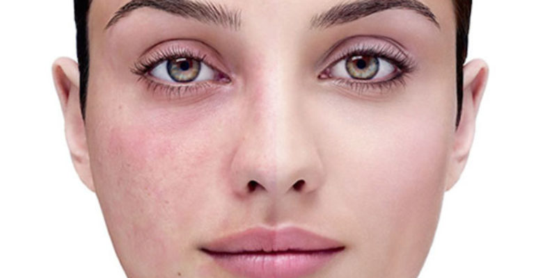 Acne, rosacea, dermatiti… le novità per la pelle