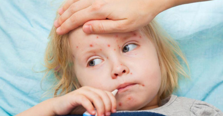 Obblighi vaccinali: il morbillo spiegato in 8 punti