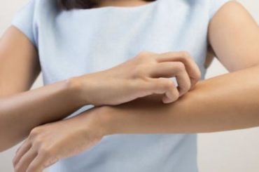 Sole, sabbia, mare e cibi causano l’orticaria, ma qualcosa si può fare