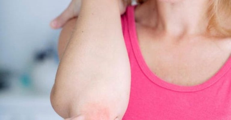 PSSSS… È ora di parlare ad alta voce della malattia psoriasica