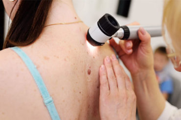 Melanoma: presentate all’ASCO nuove terapie per pazienti ad alto rischio di recidiva