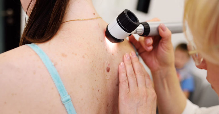 Melanoma: presentate all’ASCO nuove terapie per pazienti ad alto rischio di recidiva