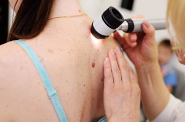 Melanoma: più del 50% dei pazienti vive grazie a due farmaci immunoterapici 