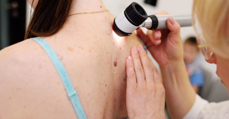 Melanoma: più del 50% dei pazienti vive grazie a due farmaci immunoterapici 