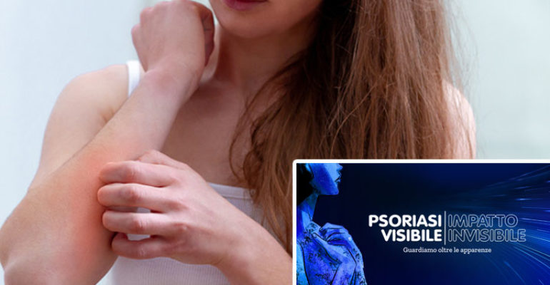 PsoPoint, la piattaforma che connette dermatologi e pazienti con psoriasi